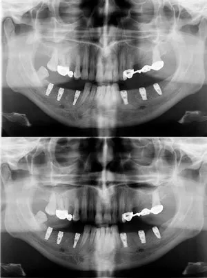 Dental Implant Experts Surprise AZ | Replacement Teeth | Tooth Implant