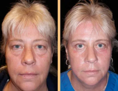 Age Spots Surprise AZ | Chemical Peels | Laser Skin Resurfacing